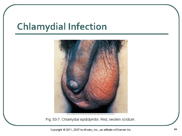 Chlamydial Infection Fig. 53 -7. Chlamydial epididymitis. Red, swollen scrotum. Copyright © 2011, 2007