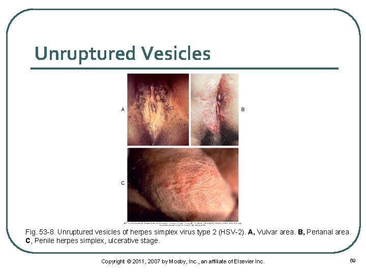 Unruptured Vesicles Fig. 53 -8. Unruptured vesicles of herpes simplex virus type 2 (HSV-2).