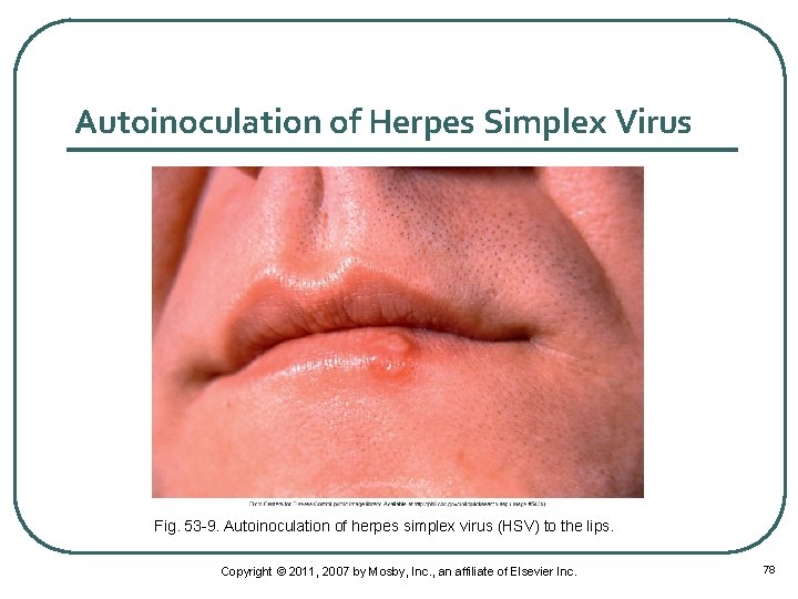 Autoinoculation of Herpes Simplex Virus Fig. 53 -9. Autoinoculation of herpes simplex virus (HSV)