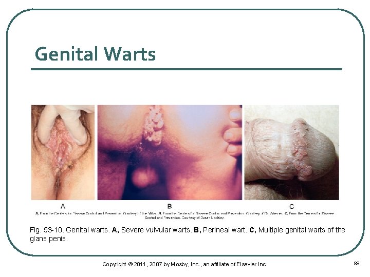 Genital Warts Fig. 53 -10. Genital warts. A, Severe vulvular warts. B, Perineal wart.