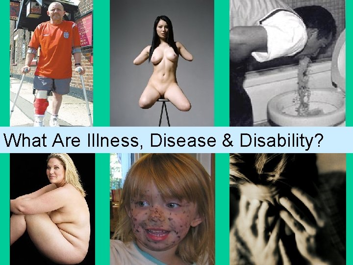 What Are Illness, Disease & Disability? 