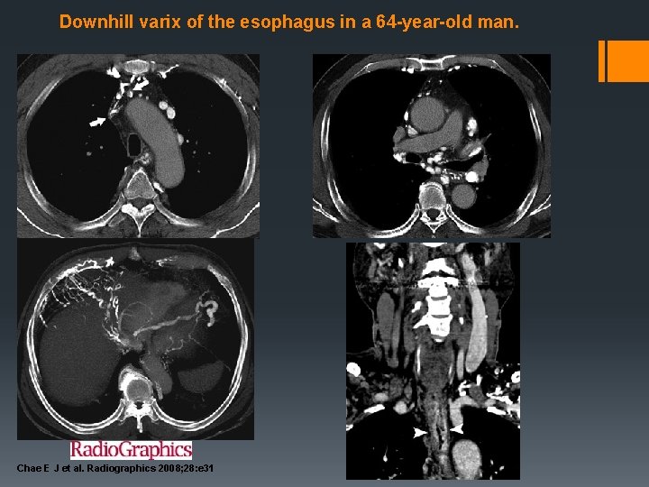  Downhill varix of the esophagus in a 64 -year-old man. Chae E J
