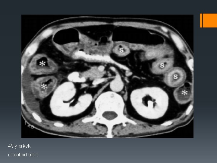 49 y, erkek. romatoid artrit 