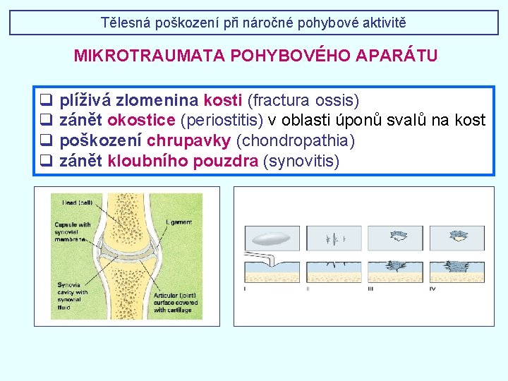 Tělesná poškození při náročné pohybové aktivitě MIKROTRAUMATA POHYBOVÉHO APARÁTU q plíživá zlomenina kosti (fractura