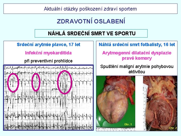 Aktuální otázky poškození zdraví sportem ZDRAVOTNÍ OSLABENÍ NÁHLÁ SRDEČNÍ SMRT VE SPORTU Srdeční arytmie