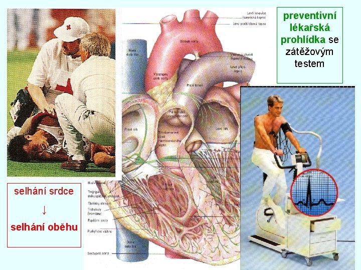 preventivní lékařská prohlídka se zátěžovým testem selhání srdce ↓ selhání oběhu 