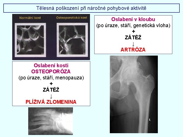 Tělesná poškození při náročné pohybové aktivitě Oslabení v kloubu (po úraze, stáří, genetická vloha)