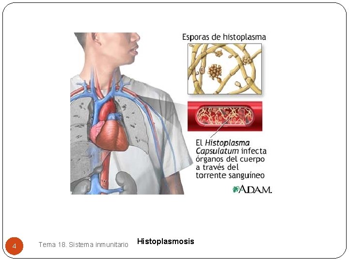 4 Tema 18. Sistema inmunitario Histoplasmosis 4 Tema 18. Sistema inmunitario Histoplasmosis