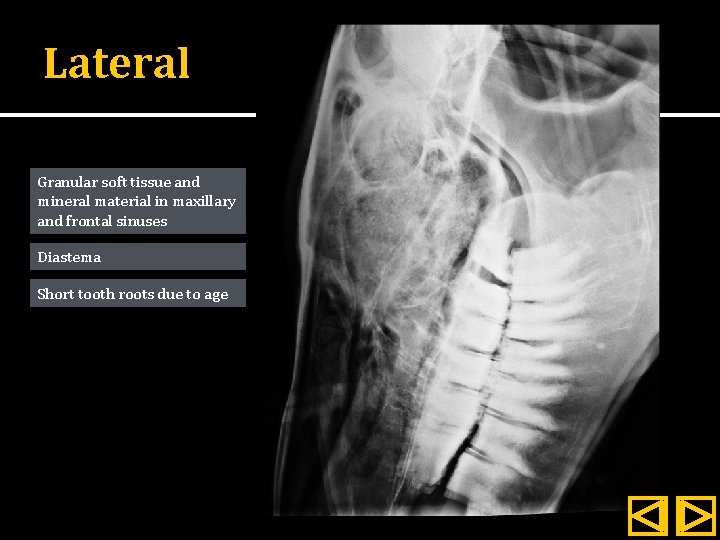 Lateral Granular soft tissue and mineral material in maxillary and frontal sinuses Diastema Short