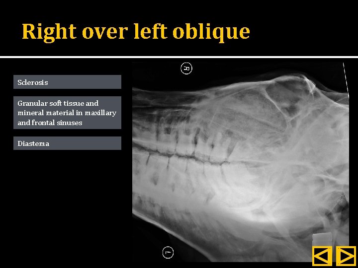 Right over left oblique Sclerosis Granular soft tissue and mineral material in maxillary and