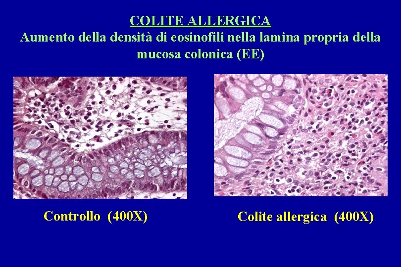 COLITE ALLERGICA Aumento della densità di eosinofili nella lamina propria della mucosa colonica (EE)