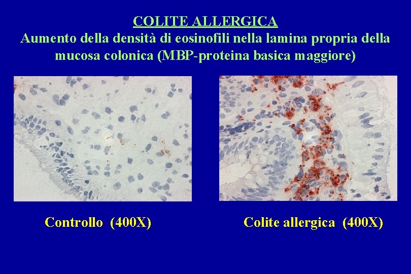 COLITE ALLERGICA Aumento della densità di eosinofili nella lamina propria della mucosa colonica (MBP-proteina