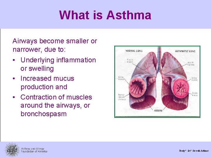 What is Asthma Airways become smaller or narrower, due to: • Underlying inflammation or