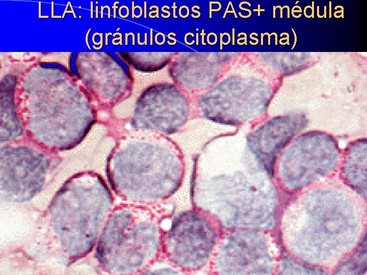 LLA: linfoblastos PAS+ médula (gránulos citoplasma) 