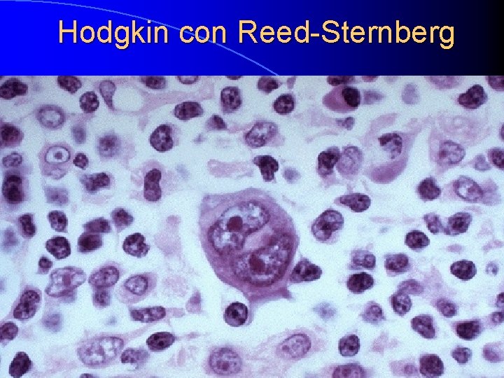 Hodgkin con Reed-Sternberg 