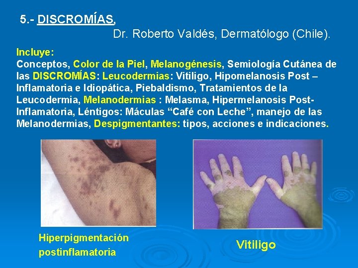 5. - DISCROMÍAS, Dr. Roberto Valdés, Dermatólogo (Chile). Incluye: Conceptos, Color de la Piel,