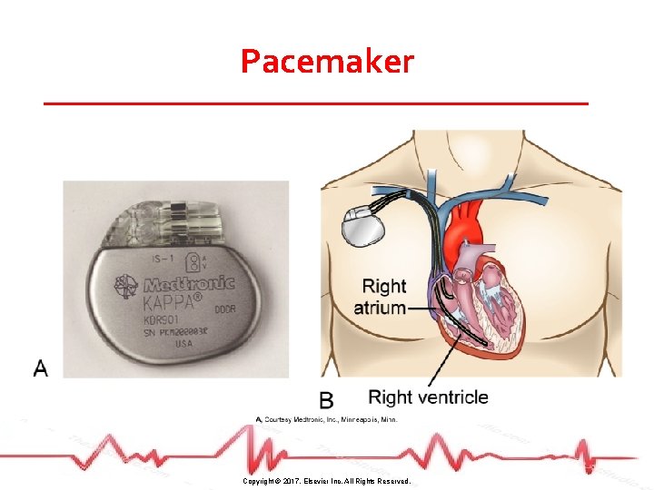 Pacemaker Copyright © 2017, Elsevier Inc. All Rights Reserved. 