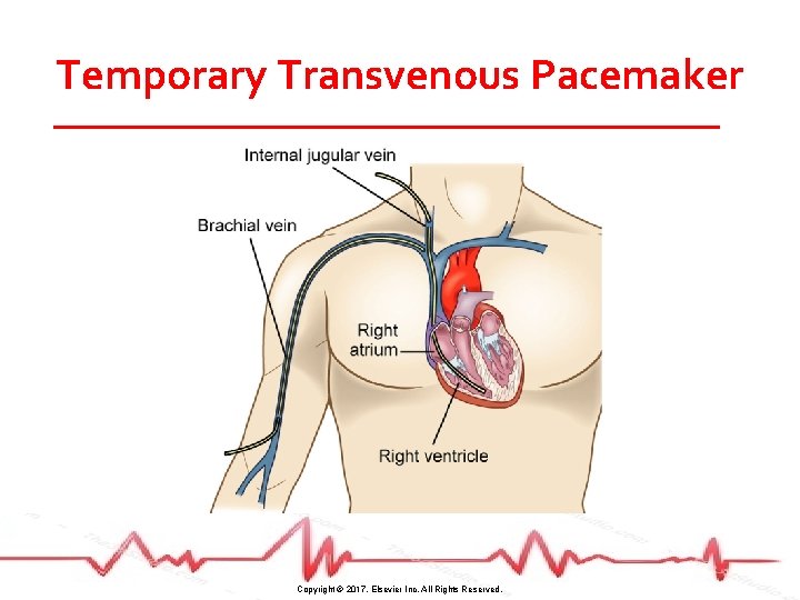 Temporary Transvenous Pacemaker Copyright © 2017, Elsevier Inc. All Rights Reserved. 