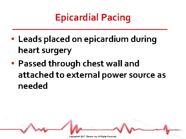Epicardial Pacing • Leads placed on epicardium during heart surgery • Passed through chest
