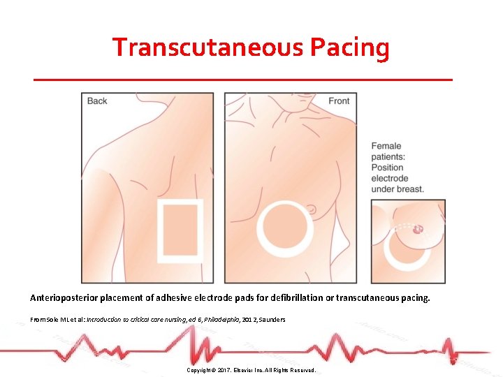Transcutaneous Pacing Anterioposterior placement of adhesive electrode pads for defibrillation or transcutaneous pacing. From