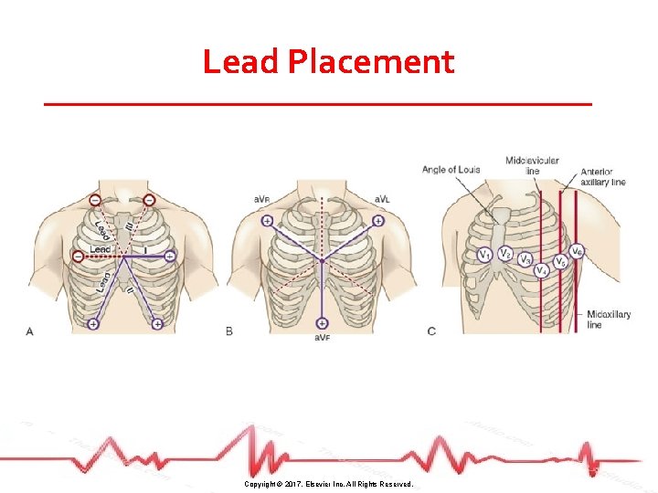 Lead Placement Copyright © 2017, Elsevier Inc. All Rights Reserved. 