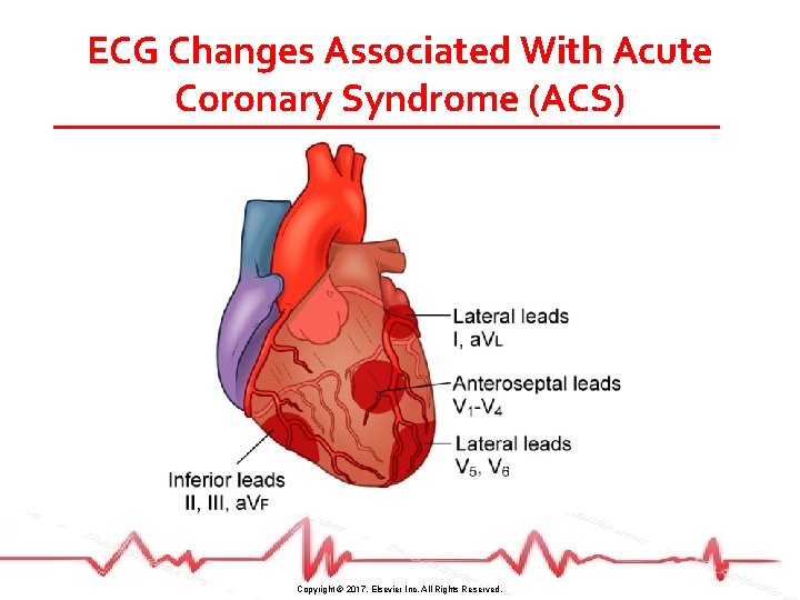 ECG Changes Associated With Acute Coronary Syndrome (ACS) Copyright © 2017, Elsevier Inc. All