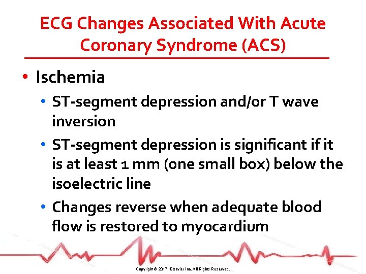 ECG Changes Associated With Acute Coronary Syndrome (ACS) • Ischemia • ST-segment depression and/or