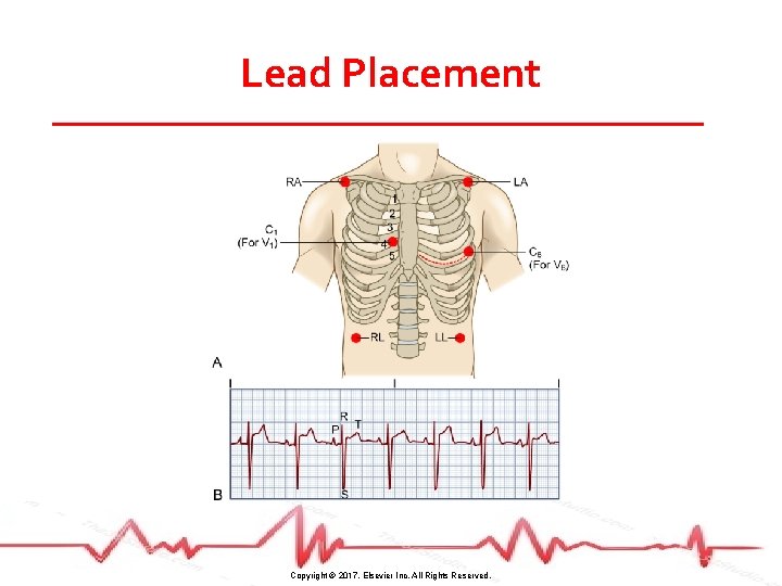 Lead Placement Copyright © 2017, Elsevier Inc. All Rights Reserved. 