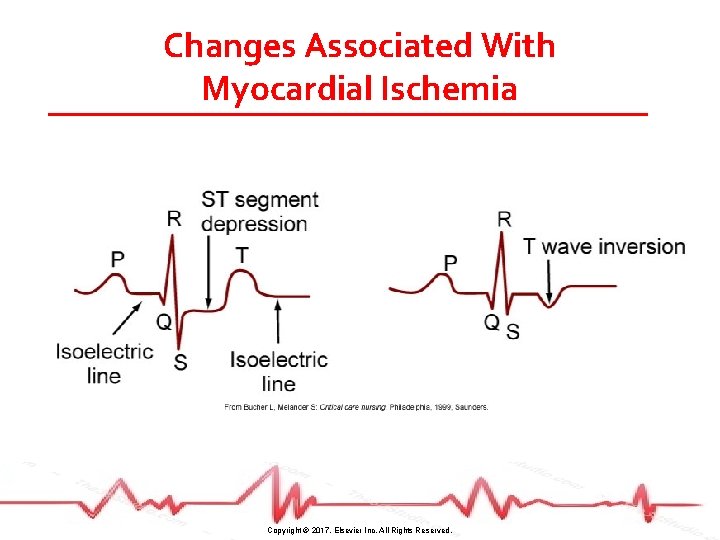 Changes Associated With Myocardial Ischemia Copyright © 2017, Elsevier Inc. All Rights Reserved. 