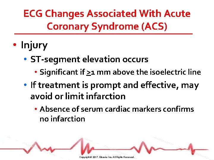 ECG Changes Associated With Acute Coronary Syndrome (ACS) • Injury • ST-segment elevation occurs
