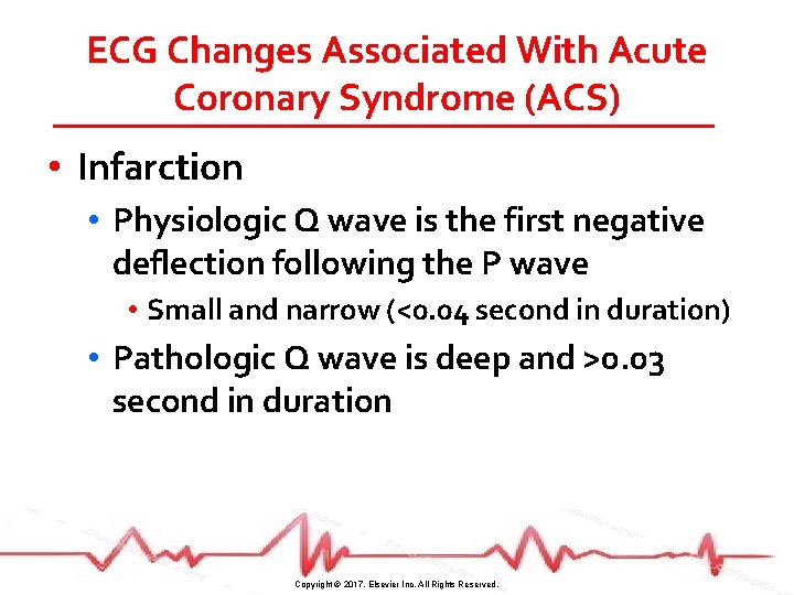 ECG Changes Associated With Acute Coronary Syndrome (ACS) • Infarction • Physiologic Q wave