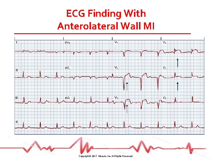 ECG Finding With Anterolateral Wall MI Copyright © 2017, Elsevier Inc. All Rights Reserved.