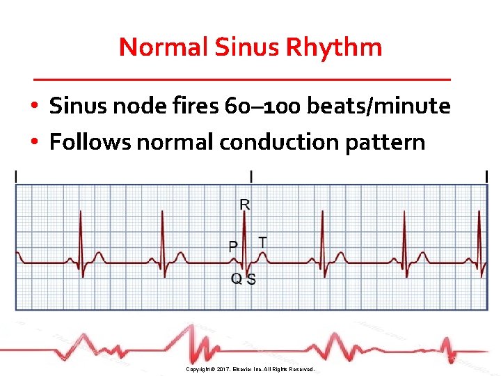 Normal Sinus Rhythm • Sinus node fires 60– 100 beats/minute • Follows normal conduction