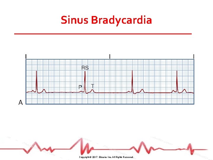 Sinus Bradycardia Copyright © 2017, Elsevier Inc. All Rights Reserved. 