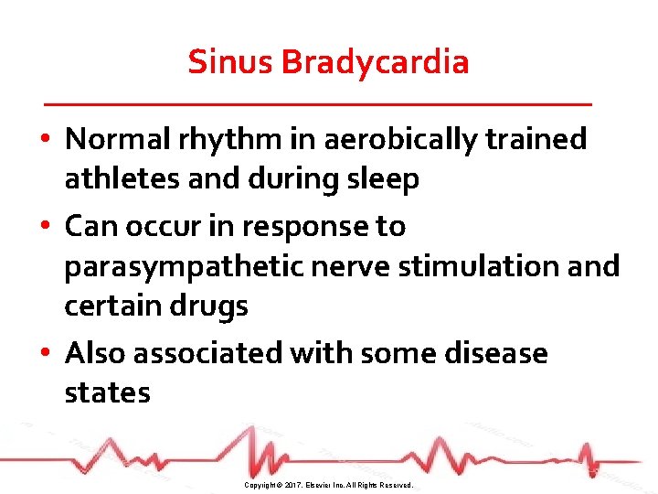 Sinus Bradycardia • Normal rhythm in aerobically trained athletes and during sleep • Can