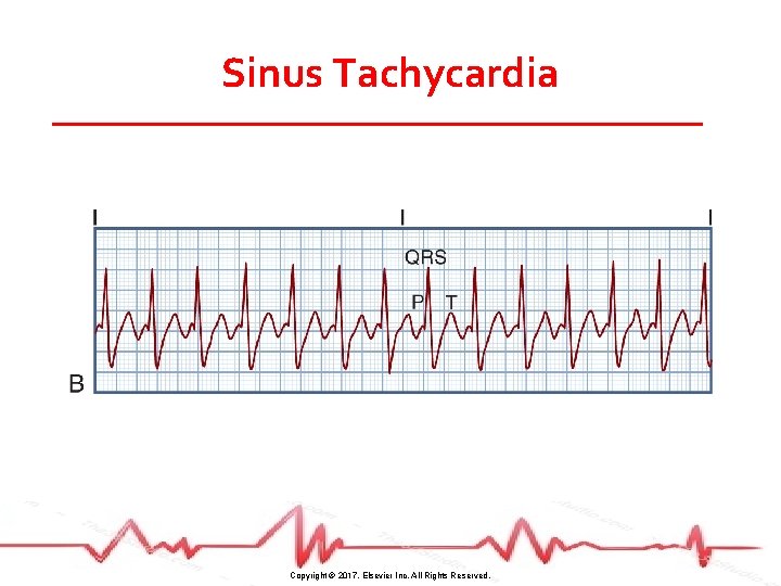 Sinus Tachycardia Copyright © 2017, Elsevier Inc. All Rights Reserved. 