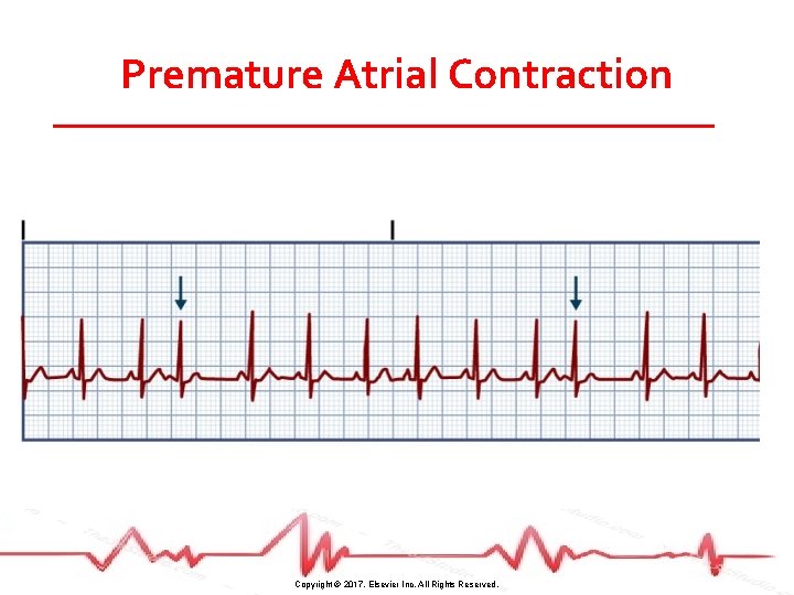 Premature Atrial Contraction Copyright © 2017, Elsevier Inc. All Rights Reserved. 