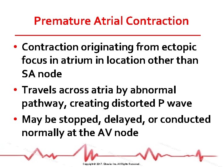 Premature Atrial Contraction • Contraction originating from ectopic focus in atrium in location other