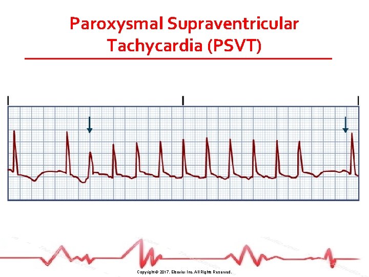 Paroxysmal Supraventricular Tachycardia (PSVT) Copyright © 2017, Elsevier Inc. All Rights Reserved. 