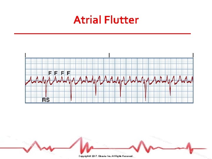 Atrial Flutter Copyright © 2017, Elsevier Inc. All Rights Reserved. 