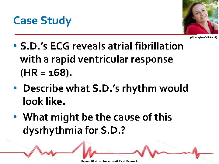 Case Study (©i. Stockphoto/Thinkstock) • S. D. ’s ECG reveals atrial fibrillation with a