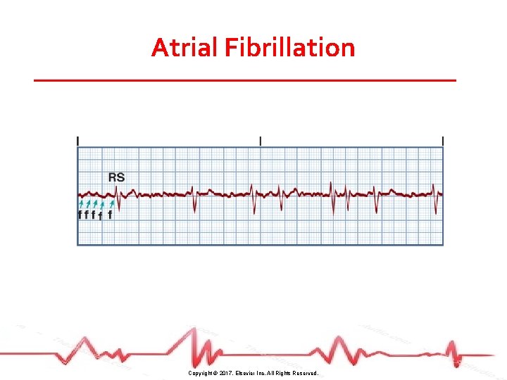 Atrial Fibrillation Copyright © 2017, Elsevier Inc. All Rights Reserved. 
