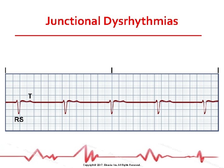 Junctional Dysrhythmias Copyright © 2017, Elsevier Inc. All Rights Reserved. 