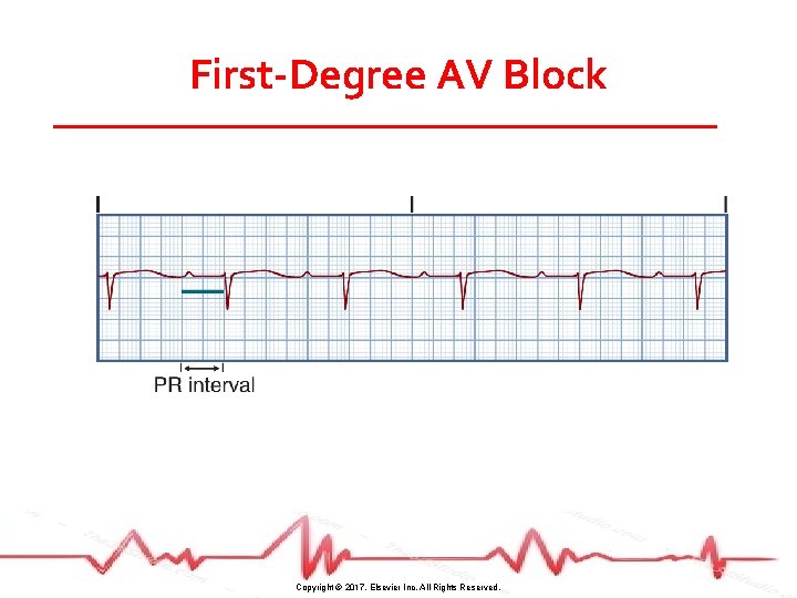 First-Degree AV Block Copyright © 2017, Elsevier Inc. All Rights Reserved. 