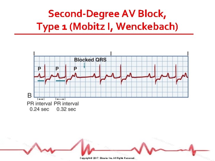 Second-Degree AV Block, Type 1 (Mobitz I, Wenckebach) Copyright © 2017, Elsevier Inc. All