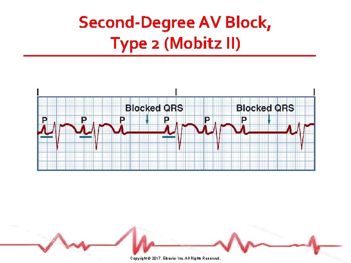 Second-Degree AV Block, Type 2 (Mobitz II) Copyright © 2017, Elsevier Inc. All Rights