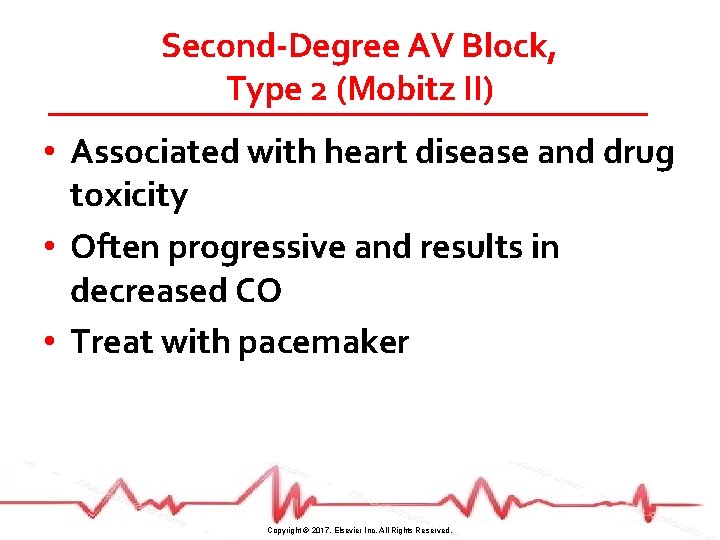 Second-Degree AV Block, Type 2 (Mobitz II) • Associated with heart disease and drug