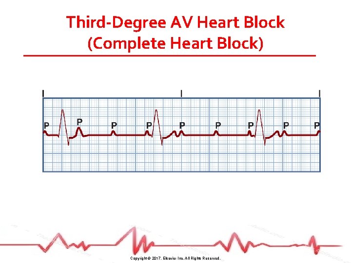 Third-Degree AV Heart Block (Complete Heart Block) Copyright © 2017, Elsevier Inc. All Rights