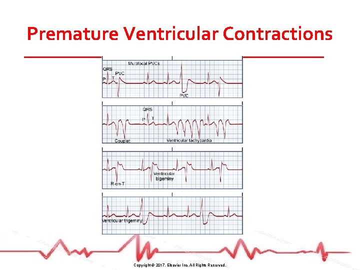 Premature Ventricular Contractions Copyright © 2017, Elsevier Inc. All Rights Reserved. 