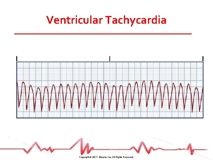 Ventricular Tachycardia Copyright © 2017, Elsevier Inc. All Rights Reserved. 